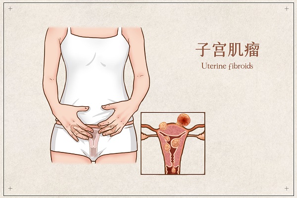 子宫肌瘤,子宫肌瘤导致不孕,子宫肌瘤做试管